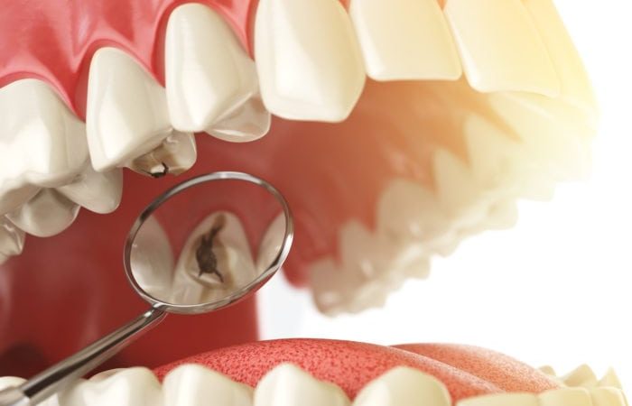 5 طرق بسيطة للتخلص من التجاويف على الاسنان
